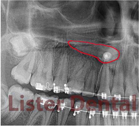 Bonding of an orthodontic bracket on impacted canine